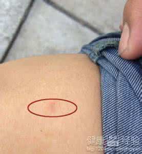 专家谈艾滋病感染几率 艾滋病感染几率