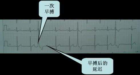 早搏是什么原因引起的 早搏是什么意思 早搏的原因有哪些