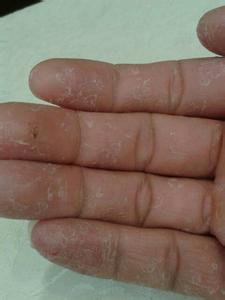 手掌脱皮怎么治疗 手掌脱皮是怎么回事 查明手掌脱皮原因