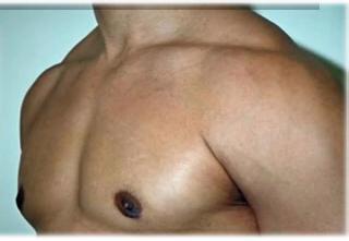 怀孕乳房中央硬结 男性使用诺雷得后乳房肿胀和硬结怎么回事