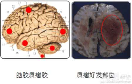 脑胶质瘤的发病原因 脑胶质瘤的发病原因 引起脑胶质瘤的原因是什么