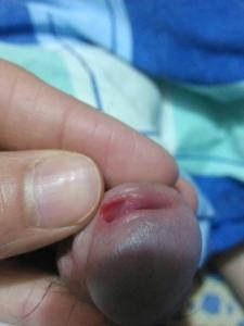 男尿道口刺痛什么原因 尿道口疼痛