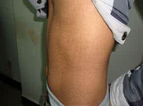 鱼鳞病的原因 鱼鳞病原因 鱼鳞病的致病原因