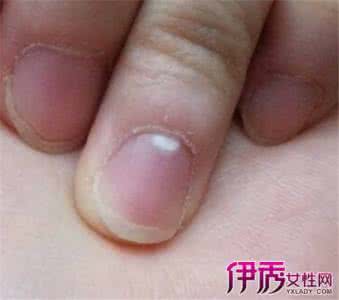 啃指甲这种小毛病 指甲里有白点是怎么回事 指甲里看出身体的小毛病