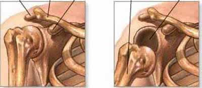 肩膀脱臼的症状 肩膀脱臼的症状 攀岩时肩膀脱臼要如何处理