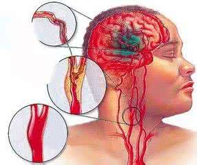 脑梗和脑溢血的区别 脑梗和脑溢血是怎么发生的