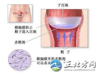 子宫帽真人使用方法图 阴道隔膜与子宫帽 阴道隔膜应该如何使用