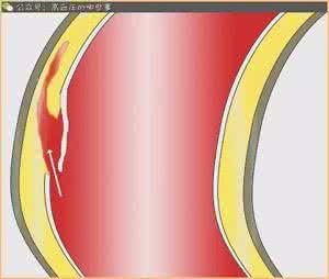 颈椎病会引起高血压吗 高血压会引起主动脉夹层，危及生命