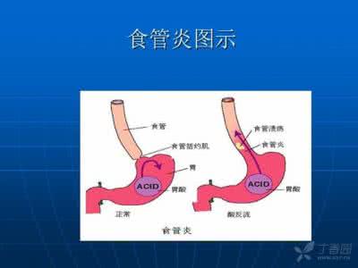 胃食管反流怎样治疗 胃食管返流病治疗共识意见