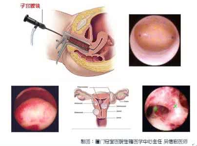 试管婴儿宫腔镜检查 试管婴儿宫腔镜检查 试管婴儿前哪些情况需要做宫腔镜检查