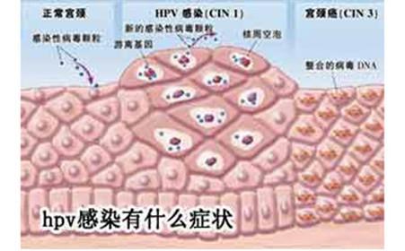 肛周脓肿如何治疗 肛周尖锐湿疣 如何治疗肛周尖锐湿疣