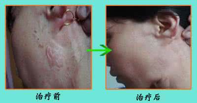 烧伤怎么去除疤痕 烧伤的老疤痕怎么去掉?