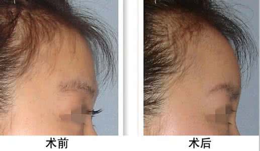 额头窄适合什么发型 额部填充的适应人群 额头窄填充手术的适应人群