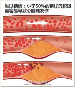 大蒜泡酒能畅通血管吗 图文：血管堵塞，一方畅通