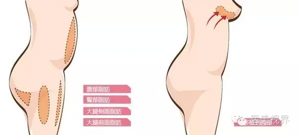 广州快速隆胸的方法 快速隆胸的方法 隆胸最快方法有哪些