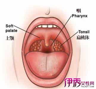 过敏性咽喉炎的症状 过敏性咽喉炎 如何预防过敏性咽喉炎