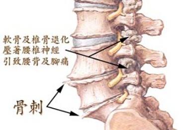 骨质增生的病因 如何治疗骨质增生 骨质增生的病因有哪些