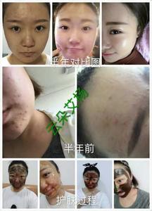 皮肤过敏中药方 皮肤过敏中药配方是什么 如何护理