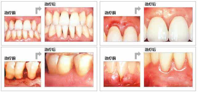 治疗牙周炎的特效药 牙周炎怎么治疗