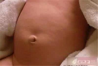新生儿肚脐突出 新生儿肚脐突出怎么回事？新生儿脐疝无需过分担心