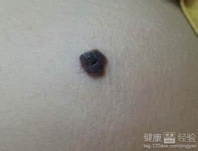 脸上的黑色素怎么去掉 吃什么可去掉黑色素