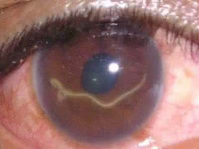 女子眼睛取出石头 恐怖慎点 女子眼睛里取出2厘米长活虫