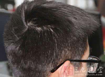 雄性激素源性脱发 雄性激素源性脱发 防治雄性激素源性脱发