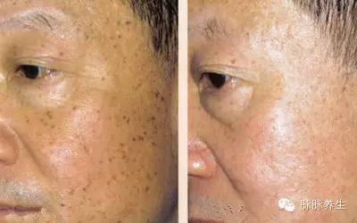 老人斑的消除方法 老人斑的天然灵丹竟然是这个! ! 也太方便了吧~