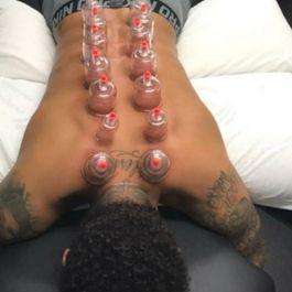 拔火罐的印子多久能消 涨知识!原来拔火罐的“罐印”暗藏了健康的秘密