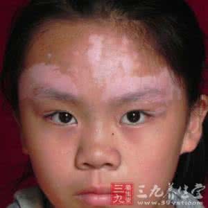 认识和了解传染病 白殿风会传染吗 你了解白殿风吗