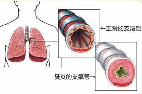 支气管炎 支气管肺炎 支气管肺炎 支气管炎有哪些症状