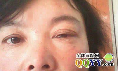 怎样治疗红眼病 怎样治疗红眼病 红眼病怎么治?