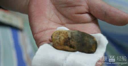 腹部发硬 上腹部发硬是胆结石吗？