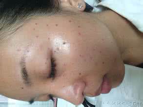 前胸后背长痘痘的原因 扁皮尤 前胸后背长痘痘是什么原因