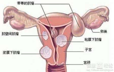 子宫肌瘤患者如何补血 子宫肌瘤患者如何补血 子宫肌瘤患者要注意哪些并发症