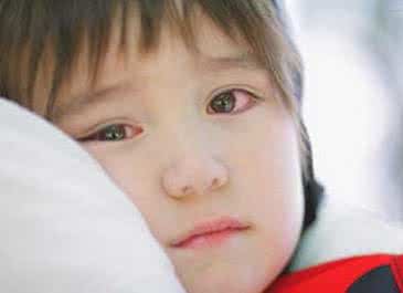 宝宝结膜炎怎么办 宝宝结膜炎 宝宝结膜炎怎么办？