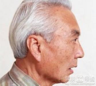脸上长老年斑民间偏方 脸上长老年斑民间偏方 治疗老年斑民间偏方