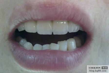 普通烤瓷牙 普通烤瓷牙 关于烤瓷牙