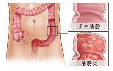 慢性肠炎的治疗方法 什么是神经性的慢性肠炎如何治疗