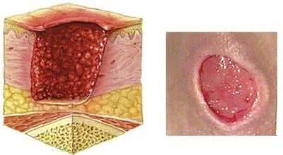 压疮的治疗方法 压疮的治疗方法 什么是压疮 压疮的治疗方法