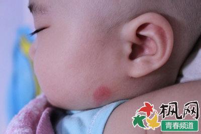 被蚊子咬最快消肿止痒 被蚊子咬最快消肿止痒 被毒蚊子咬了怎么办？蚊子咬了怎么消肿止痒