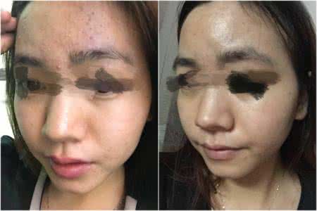 班赛对哪种痘痘 班赛可以用来治疗痘痘吗