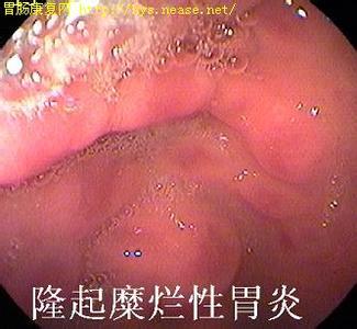 糜烂性胃炎严重吗 糜烂性胃炎严重吗 正确对待糜烂性胃炎