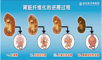 肾脏纤维化 肾脏纤维化 造成它的原因有哪些