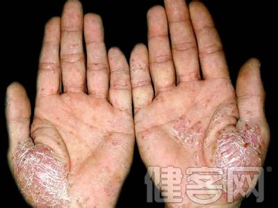 先天性免疫的特点 银屑病特点 先天性银屑病的特点