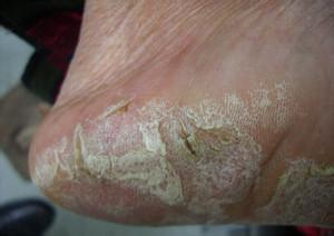 嘴唇干裂疼痛怎么办 脚汗增多干裂疼痛或是真菌感染