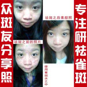 激光祛斑后如何补水 关于水是如何祛斑的