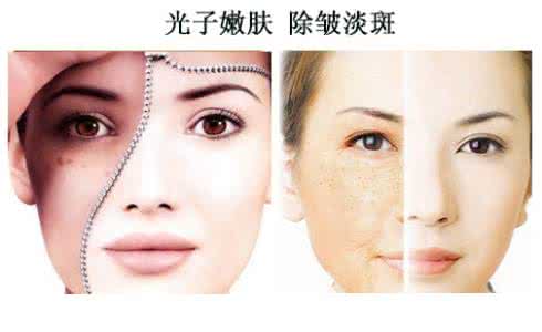 光子嫩肤的危害十年 光子嫩肤的功效 光子嫩肤的功效有哪些?