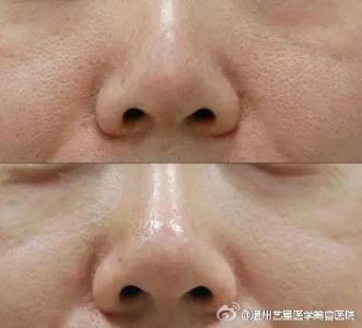 毛孔粗大如何改善 毛孔粗大 改善毛孔粗大