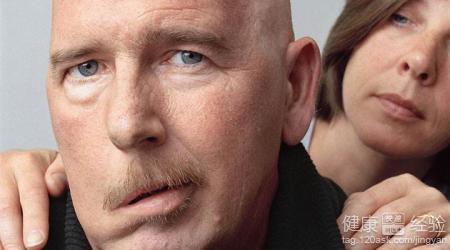 面瘫的前兆有哪些症状 面瘫前兆症状 面瘫前兆 面瘫会出现什么样前兆症状